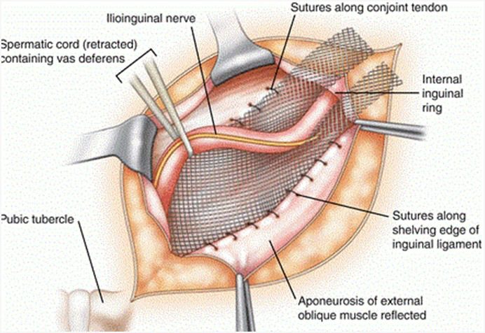 Inguinal Hernia