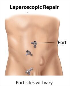 Inguinal Hernia