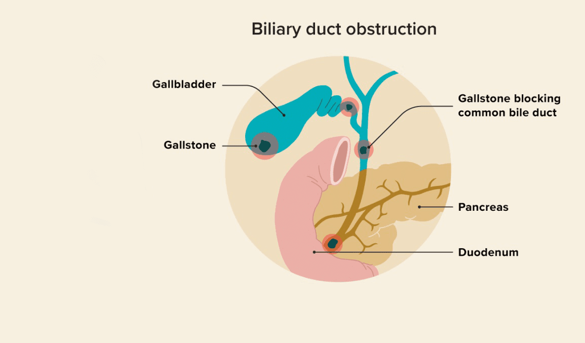 Hernia Medical Illustration