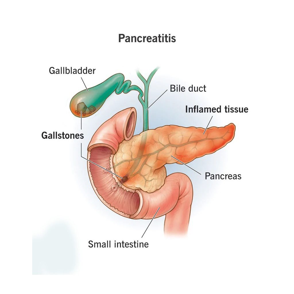 Hernia Medical Illustration