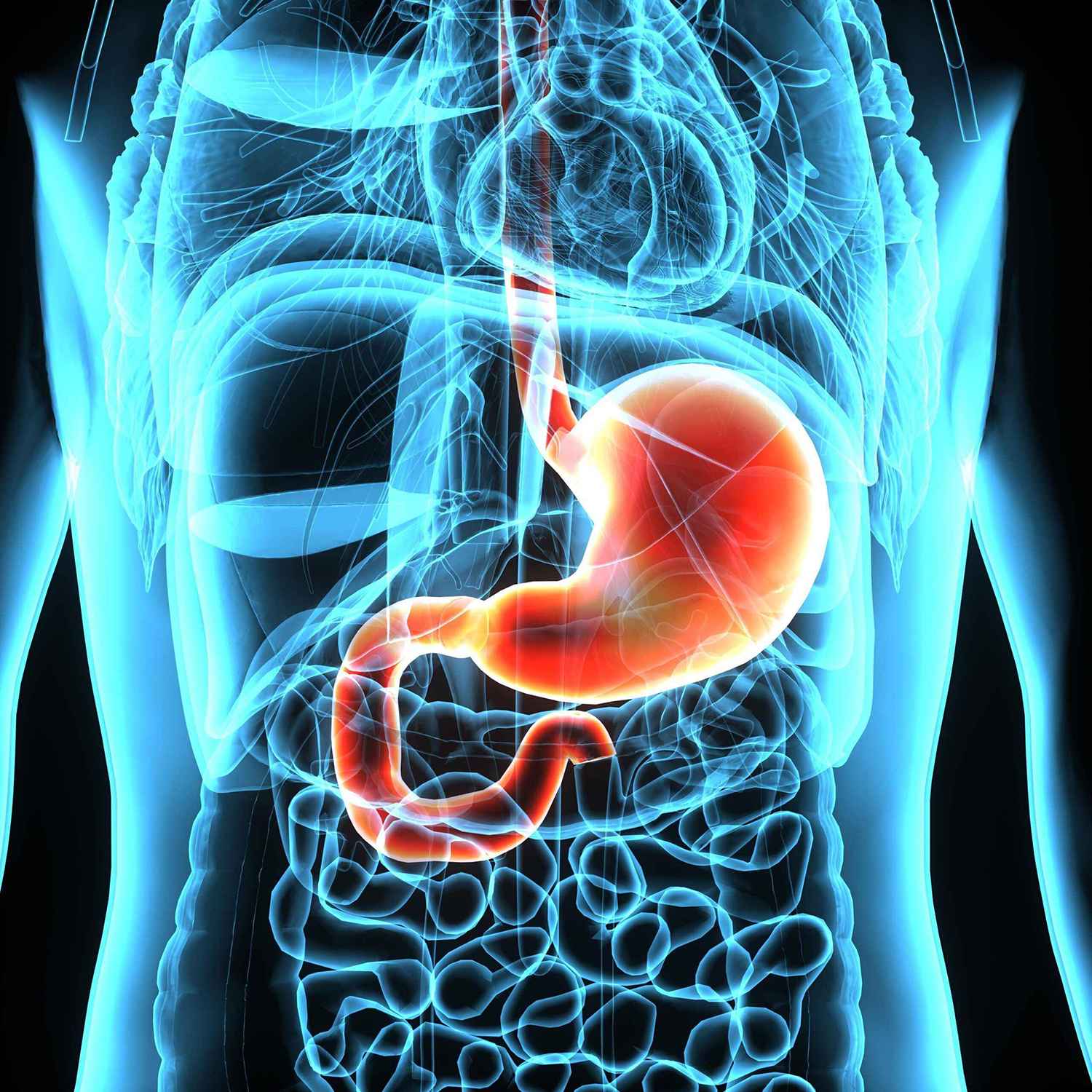 Hernia Medical Illustration