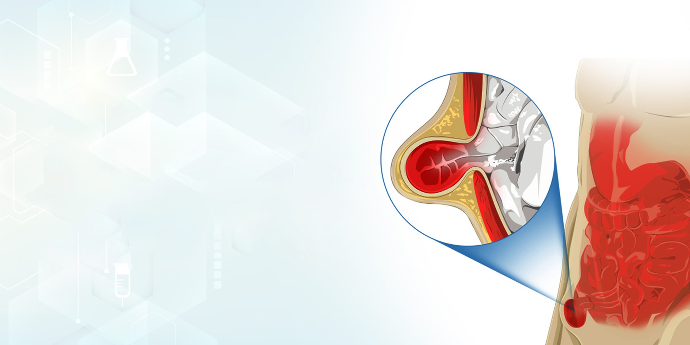 Hernia Medical Illustration