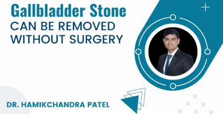 Gallbladder stone can be removed without surgery