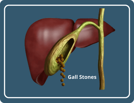 Gallbladder stone can be removed without surgery
