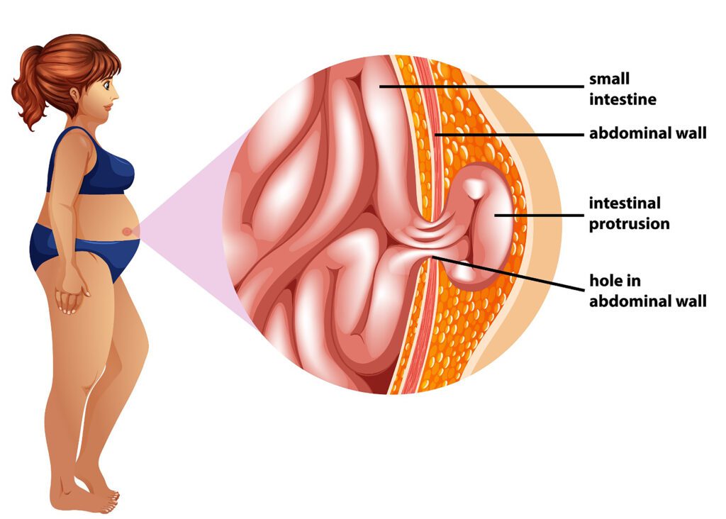 Hernia in Women