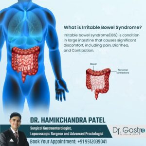 Irritable Bowel Syndrome
