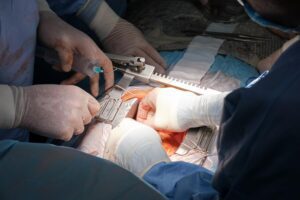 Fistula Surgery