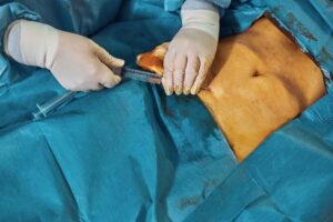 Fistula Surgery