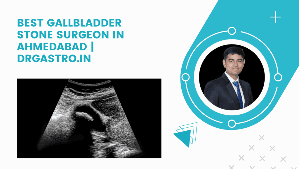 Best Gallbladder Stone Surgeon in Ahmedabad | DrGastro.in
