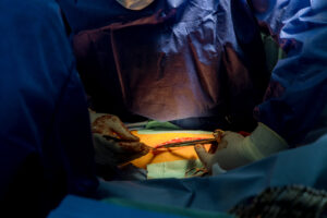 Best Hernia Surgeon in Ahmedabad