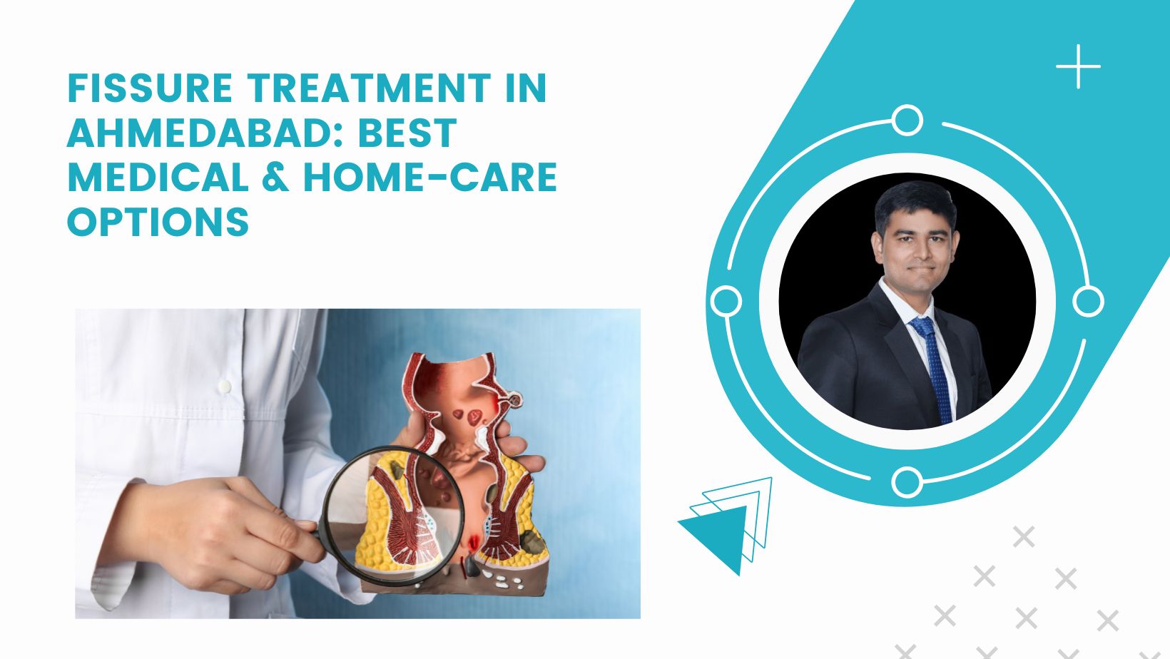 Fissure Treatment in Ahmedabad