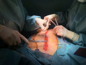 Fistula Treatment in Ahmedabad