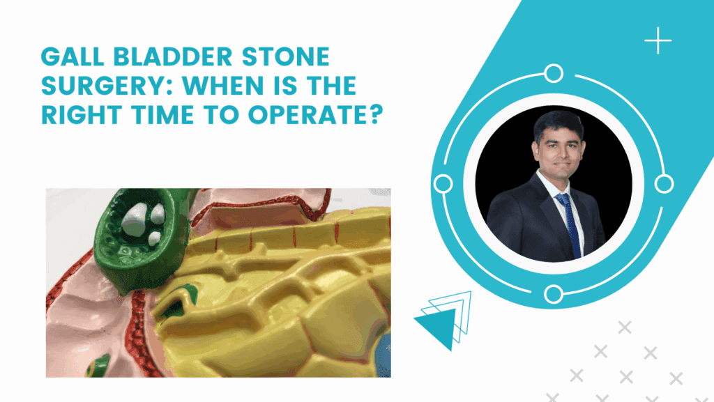 Gall Bladder Stone Surgery: When Is the Right Time to Operate?