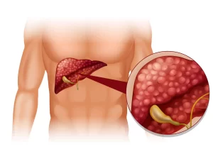 Gall Bladder Treatment in Ahmedabad