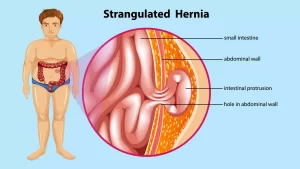 hernia surgery in ahmedabad