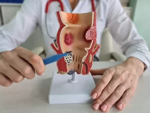 anal canal disorder