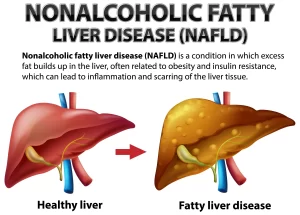 fatty liver