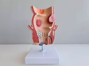 piles treatment