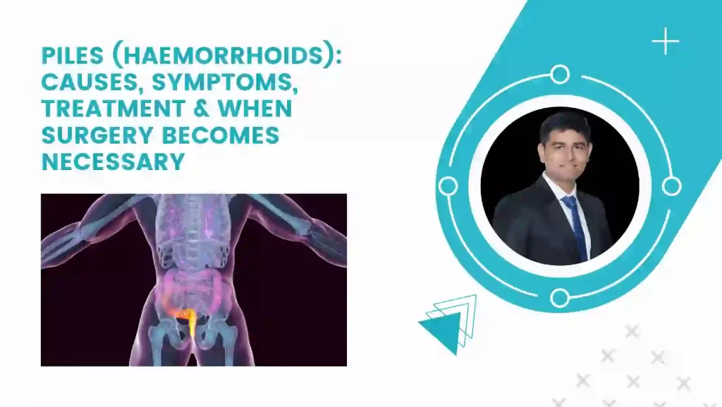 Piles (Haemorrhoids): Causes, Symptoms, Treatment & When Surgery Becomes Necessary